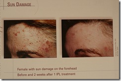 sundamageforehead